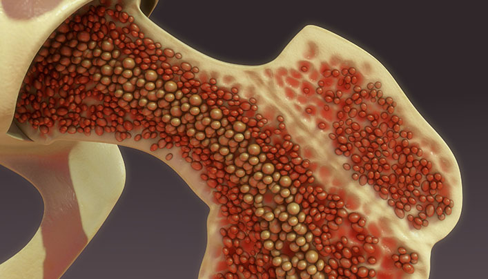 10_06_2019-medula_ossea_707x404